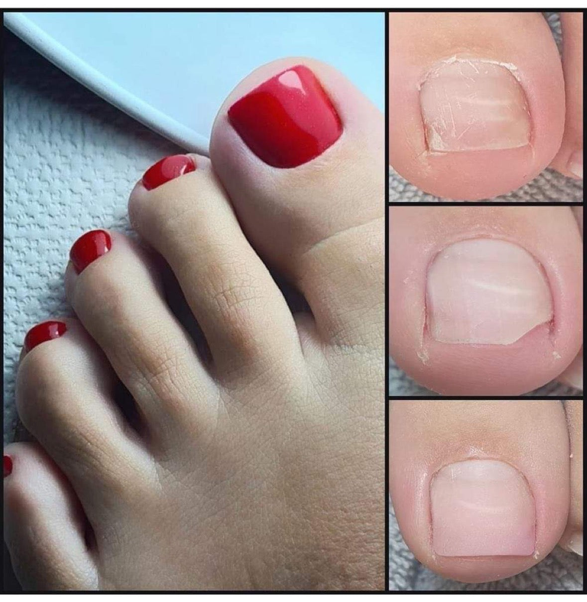 Anti fungus pedi gel