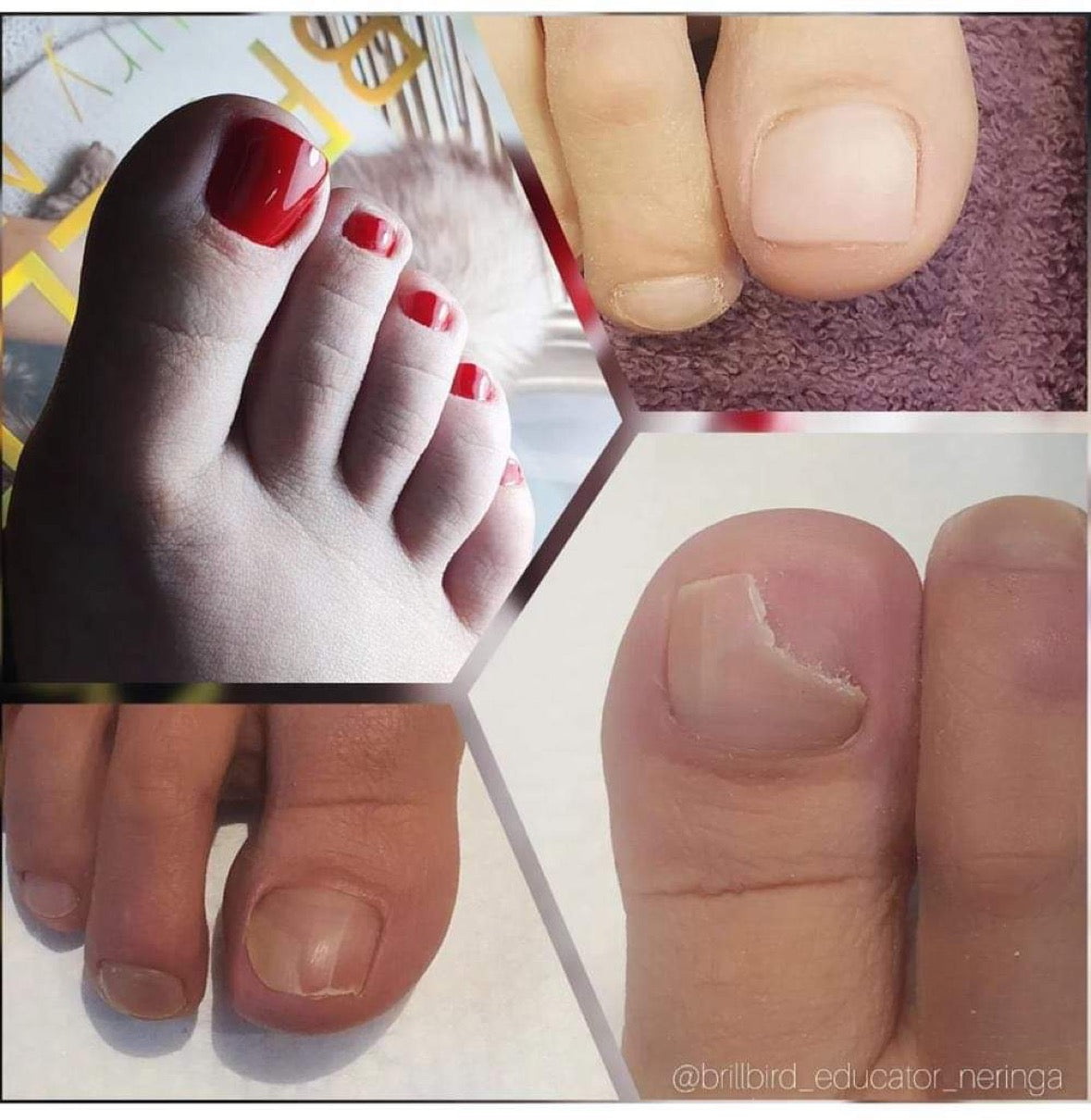 Anti fungus pedi gel